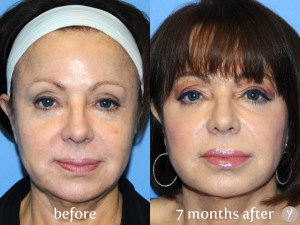 Y LIFT® - Before & Next Day – Accentuated cheekbones, rejuvenated under eye area, added definition to the jawline, lifted and improved the neck. Actual Patient