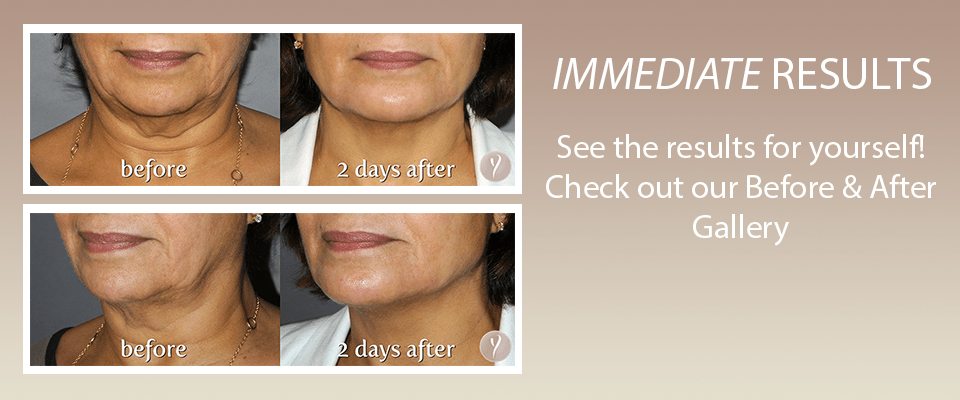 Saggy Jowls Treatment Before and After Photos
